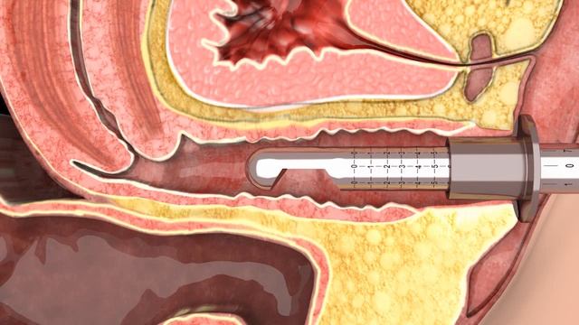 Фракционный CO2-лазер смотреть онлайн
