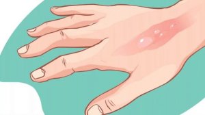 ТОП-5 Способов ЛЕЧЕНИЯ эфирным маслом ЧАЙНОГО дерева!