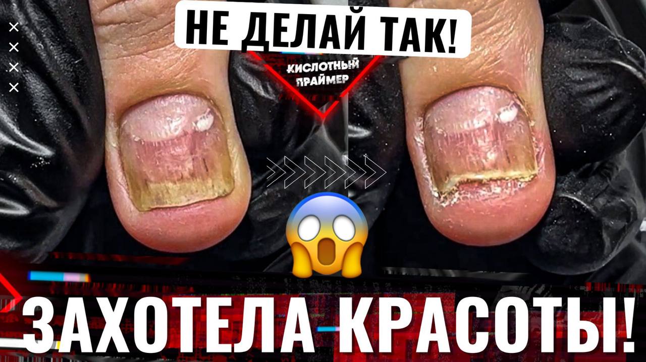 ?ИСТОРИЯ ОДНОГО НОГТЯ..? СНОВА ОНИХОЛИЗИС ногтей на руках? Что делать? Решение.