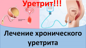 Лечение хронического уретрита