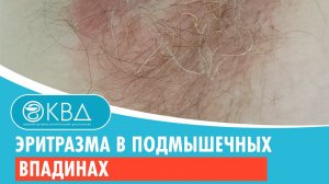 Эритразма в подмышечных впадинах. Клинический случай №137