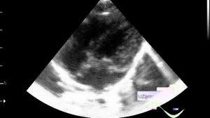 Эхокардиография - Выпот в полости перикарда