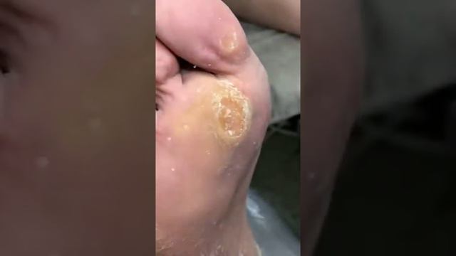 Натоптыш стержневая мозоль! Обработка глазками и колпачком смотреть онлайн