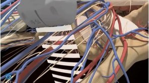 3D-пособие: Блокада подкожного нерва под контролем ультразвука -- ультразвуковая система SonoSite