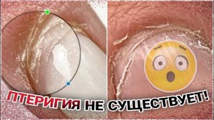 Птеригия не существует!