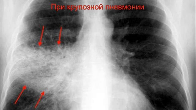 Целительная сила куринных и перепелинных яиц, лечение инъекциями живого яйца