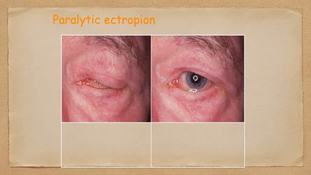 Entropion and Ectropion by Dr. Eman Sultan - GOTHI MIOR Clinical Exams Guiding Course