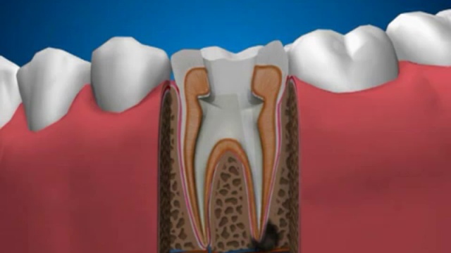 Периодонтит зубов и его лечение смотреть онлайн