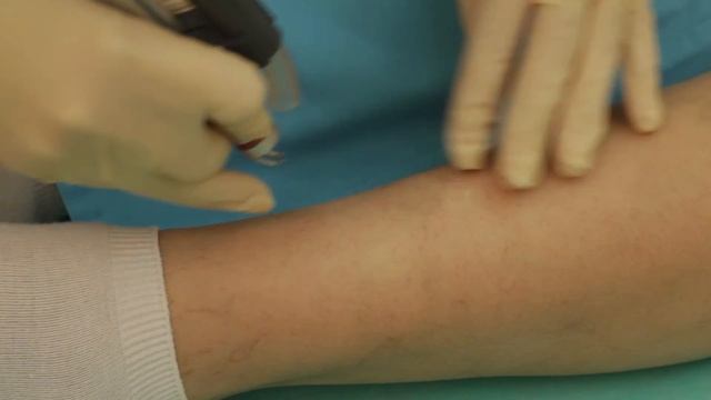 Удаление сосудистых звездочек лазером в Алматы — MLC смотреть онлайн