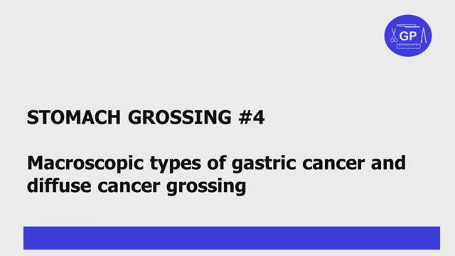 Macroscopic types of gastric cancer and diffuse cancer grossing