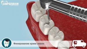 Лечение глубокого кариеса: этапы лечения глубокого кариеса.