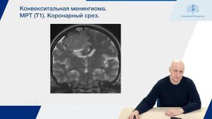 Лекция - опухоли головного мозга. Часть 1.