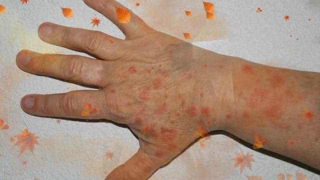 Пищевая аллергия симптомы диета и лечение