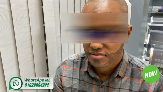 Beard Transplant Surgery Before and After In Bangladesh | Kamal Hair And Skin Center | смотреть онлайн