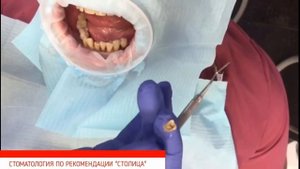 ? Причины и способы устранения подвижности зубов. Подвижность зубов. Столица. 12+