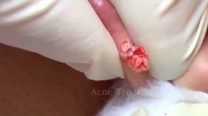 Pimple popping | Cyst popping | Как убрать угорь на ухе