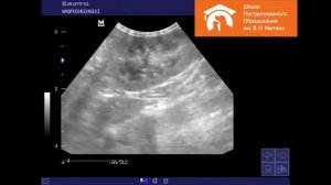 Гиперплазия надпочечника.