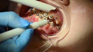 Ретинированные зубы – полный гайд по их выравниванию