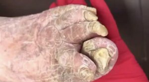 Зачистка сложных ногтей