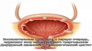 Опасность цистита и его виды