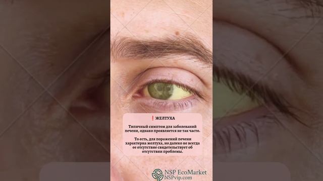 СИМПТОМЫ ЗАБОЛЕВАНИЯ ПЕЧЕНИ