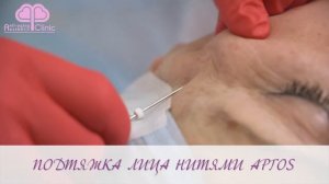 Установка нитей для подтяжки лица