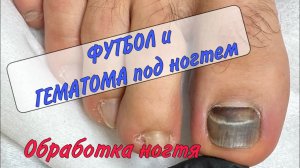 🍷ГЕМАТОМА под ногтем _ синяк под ногтем _ ушиб пальца