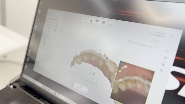 Цифровое 3D сканирование зубов