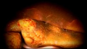 Жизнь с одной почкой