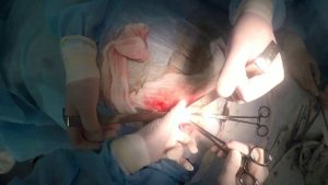 Аппендэктомия лапаротомия по Волковичу Дьякову