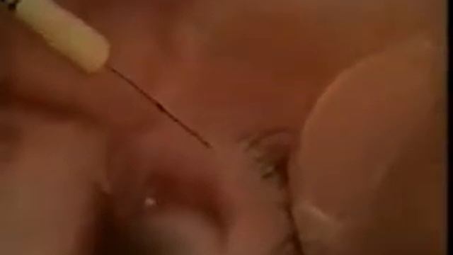 ЭПИЛЯЦИЯ ВЕКО