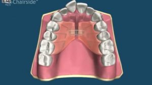 Съемные ортодонтические аппараты