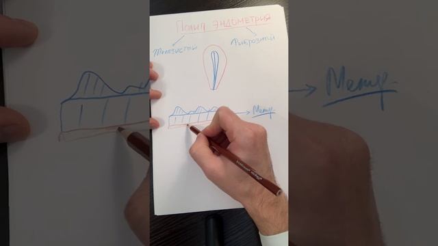 ПОЛИП ЭНДОМЕТРИЯ