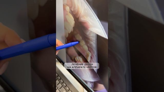 Лечение и укрепления десен зубов