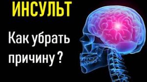 Инсульт головного мозга. Причина инсульта, восстановление, лечение, профилактика