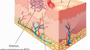 Как избавиться от бородавок и папиллом ЗА 1 ДЕНЬ !!!