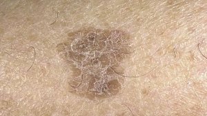 Удаление кератомы.