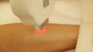 IPL / SHR (Super Hair Removal) in motion - фотоэпиляция.