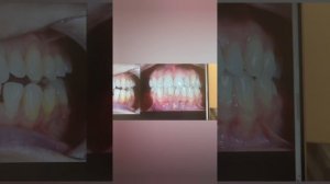 В 40 лет можно ставить аппарат Planas для работы с прикусом? Будет ли он работать и когда результат