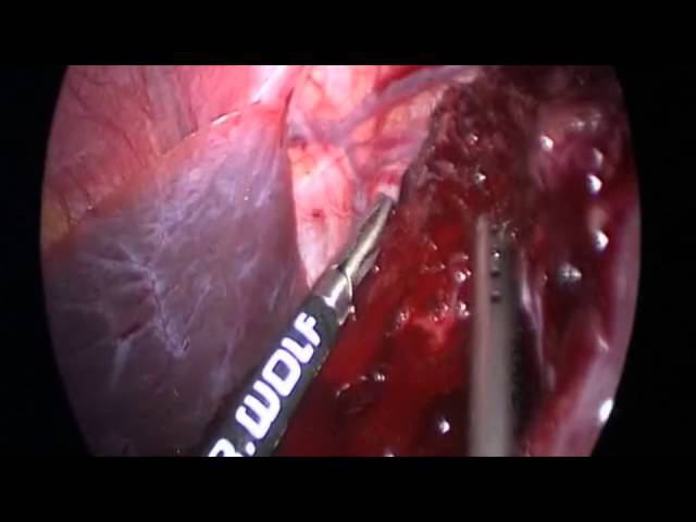 Laparoscopic Splenic cyst resection (резекция кисты селезенки) Abolmasov A. смотреть онлайн