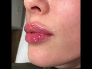 Аугментация губ