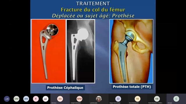 Visioconf - Ortho : Fractures extremité supérieure du fémur смотреть онлайн