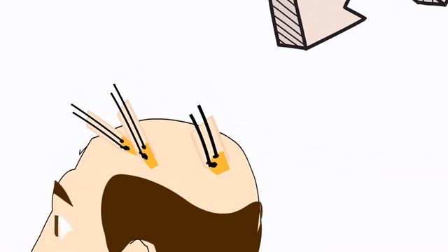 Пересадка волос Strip смотреть онлайн