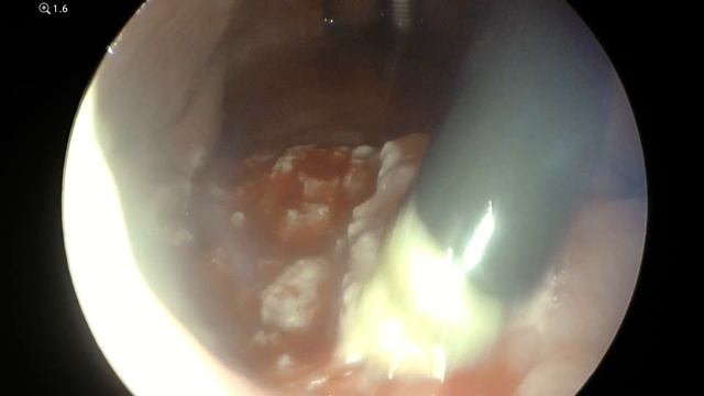 4K Coblation Adenotomie смотреть онлайн