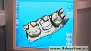 Церек технология керамической реставрации, Cerec