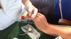 Извлечение тройника из мизинца