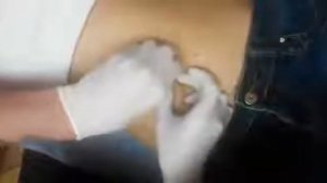 Прокол пупка.