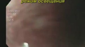 Перстневидноклеточный рак желудка  Гастроскопия