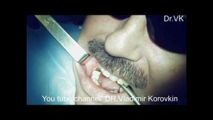 Отслаивание слизисто - надкостничного лоскута, область 46 для установки импланта.