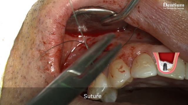 Sinus elevation with GBR simultaneously (Short) - Prof. Jung-Chul Park смотреть онлайн